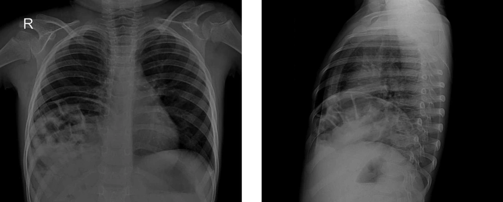 In the anterior posterior and lateral chest X-ray, the right hemi-diaphragm is obscured and elevated. There are multiple loop-like lucencies at the right lower lung zone, suspicious of diaphragmatic hernia, associated with an ill-defined opacity. In the anterior posterior and lateral chest X-ray, the right hemi-diaphragm is obscured and elevated. There are multiple loop-like lucencies at the right lower lung zone, suspicious of diaphragmatic hernia, associated with an ill-defined opacity.