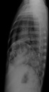 Ectopic Intrathoracic Kidney Along with Right Anterior Diaphragmatic Hernia