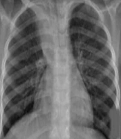 Cover image of the article: Cast Bronchitis in a Cystic Fibrosis Child: Experience with Direct Instillation of Dornase Alfa as an Adjunct Treatment Agent
