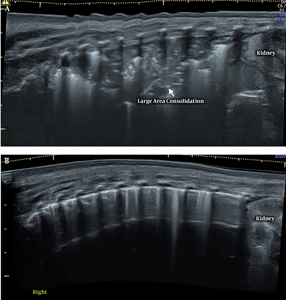 BAL for treating severe MAS. A, Before BAL. LUS shows a large area of lung consolidation with significant air bronchograms in the whole right lung field. B, After BAL. LUS shows a nearly completely normal lung field; the consolidation has completely disappeared. BAL for treating severe MAS. A, Before BAL. LUS shows a large area of lung consolidation with significant air bronchograms in the whole right lung field. B, After BAL. LUS shows a nearly completely normal lung field; the consolidation has completely disappeared.