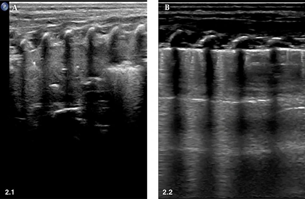 BAL for treating severe MAS. A, Before BAL. LUS shows a large area of lung consolidation with air bronchograms in the left lung. B, After BAL. LUS shows that the lung consolidation has completely disappeared, and the lungs have returned to normal. BAL for treating severe MAS. A, Before BAL. LUS shows a large area of lung consolidation with air bronchograms in the left lung. B, After BAL. LUS shows that the lung consolidation has completely disappeared, and the lungs have returned to normal.