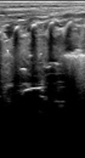 Bronchoalveolar Lavage to Treat Neonatal Meconium Aspiration Syndrome Under Monitoring of Lung Ultrasound Based on a Prospective Case Series Study