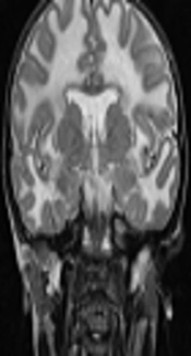 An Asymptomatic Case of Megalencephalic Leukoencephalopathy with Subcortical Cysts