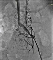 Arterial and Venous Complications Early After Cardiac Catheterization in Children and Adolescents: A Prospective Study