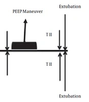 Slow Positive End-Expiratory Pressure Titration During General Anesthesia with Muscle Paralysis Improves Lung Function Without Compromising Hemodynamic Stability in Preschool Children: A Randomized Control Clinical Trial