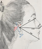 Craniofacial Morphometric Measurements of Children with Celiac Disease