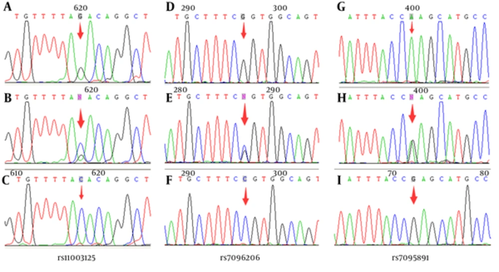 Representative DNA Sequencing Analysis for <i>MBL2</i> Promoter Polymorphisms A - C, genotypes of rs11003125; D - F, genotypes of rs7096206; G - I, genotypes of rs7095891.