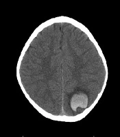 Brain Computed Tomography Scan Findings in Children with Neurological Impairment During the Early Postoperative Period of Open-Heart Surgery for Congenital Heart Disease