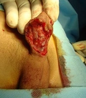 Improving the Penile Skin Adequacy and Appearance by Patching of the Preputial Skin Island Flap (PSIF) in Distal and Midshaft Hypospadias Associated with Severe Ventral Skin Deficiency: Experience in 224 Cases
