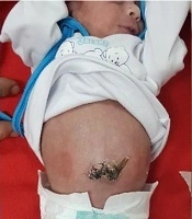 Intra-Operative Total Bowel Washing: A New Method to Improve the Outcome of Gastroschisis Primary Repair