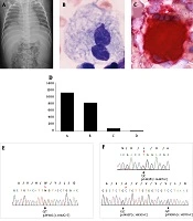 New Variant Mutation of Glucosylceramidase Beta (GBA) and Early Enzyme Replacement Therapy for Neuronopathic Gaucher Disease: A Case Report and Literature Review