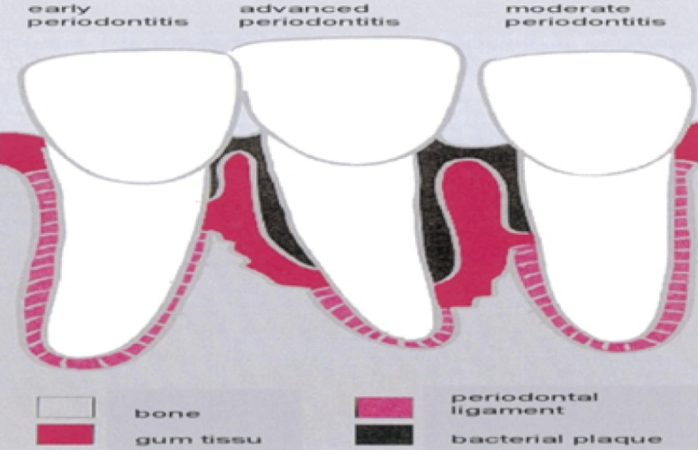 Bacteria in subgingival plaque have caused a periodontal pocket to develop, inflaming surrounding tissue and causing loss of alveolar bone (<a href="#B5">5</a>).
