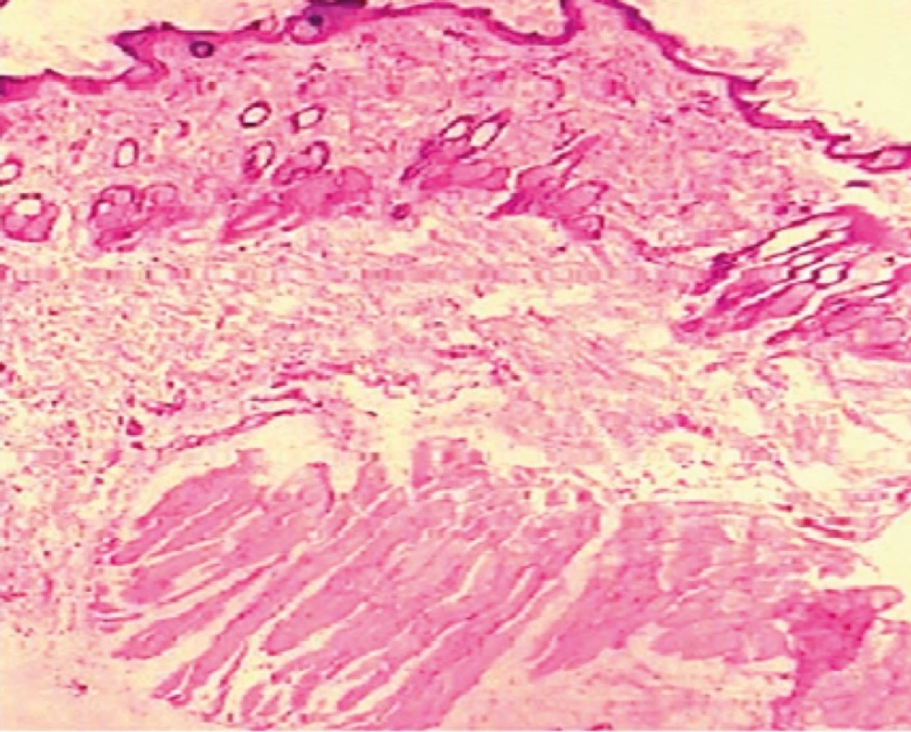 Light power photomicrograph of treated skin