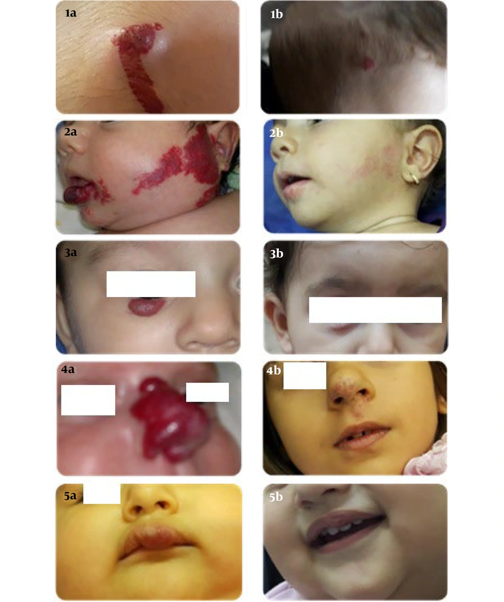 1-5A, before; and 1-5B, after; photos of propranol-treated infants' hemangioma in the scalp, face, around the eyes, nose, and lips, respectively 1-5A, before; and 1-5B, after; photos of propranol-treated infants' hemangioma in the scalp, face, around the eyes, nose, and lips, respectively