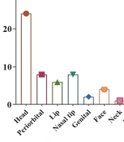The Efficacy and Safety of Propranolol in Treating Infantile Hemangioma: A Prospective Study