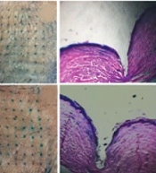 A Long-Lasting Triamcinolone-Loaded Microneedle Patch for Prolonged Dermal Delivery
