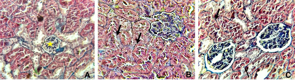 Histopathological alterations in the kidney in different groups examined by Masson’s trichrome (X400). A, the control group showing normal glomerular (yellow star), interstitial, and perivascular collagen, B, rats received 25 mg/kg of silica nanoparticles (SiNPs) showing mild interstitial fibrosis (arrow), and C, rats received 100 mg/kg of SiNPs showing marked interstitial fibrosis (arrow). Histopathological alterations in the kidney in different groups examined by Masson’s trichrome (X400). A, the control group showing normal glomerular (yellow star), interstitial, and perivascular collagen, B, rats received 25 mg/kg of silica nanoparticles (SiNPs) showing mild interstitial fibrosis (arrow), and C, rats received 100 mg/kg of SiNPs showing marked interstitial fibrosis (arrow).