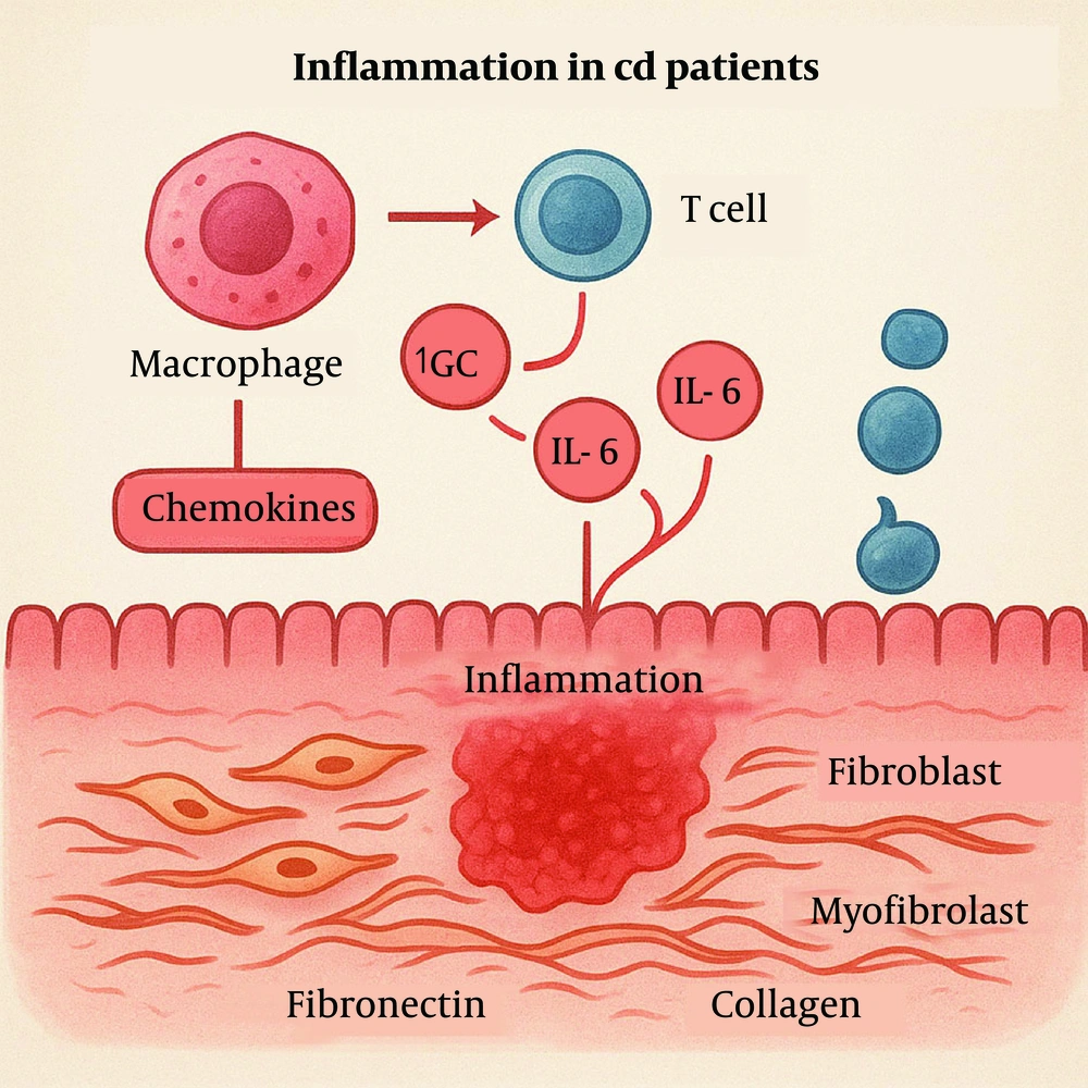 Abnormal immune activation triggers intestinal inflammation through excessive cytokine release and immune cell recruitment, which drives fibroblast activation and excessive extracellular matrix (ECM) deposition, leading to fibrous tissue buildup. Abnormal immune activation triggers intestinal inflammation through excessive cytokine release and immune cell recruitment, which drives fibroblast activation and excessive extracellular matrix (ECM) deposition, leading to fibrous tissue buildup.