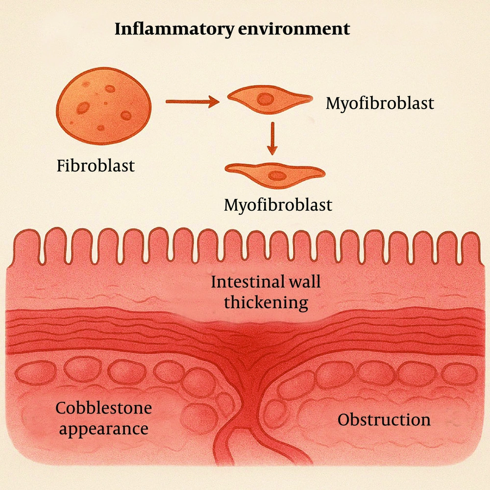 Inflammation activates fibroblasts into myofibroblasts, which produce excess extracellular matrix (ECM). This causes intestinal wall thickening, a cobblestone appearance, and can lead to stricture or obstruction. Inflammation activates fibroblasts into myofibroblasts, which produce excess extracellular matrix (ECM). This causes intestinal wall thickening, a cobblestone appearance, and can lead to stricture or obstruction.