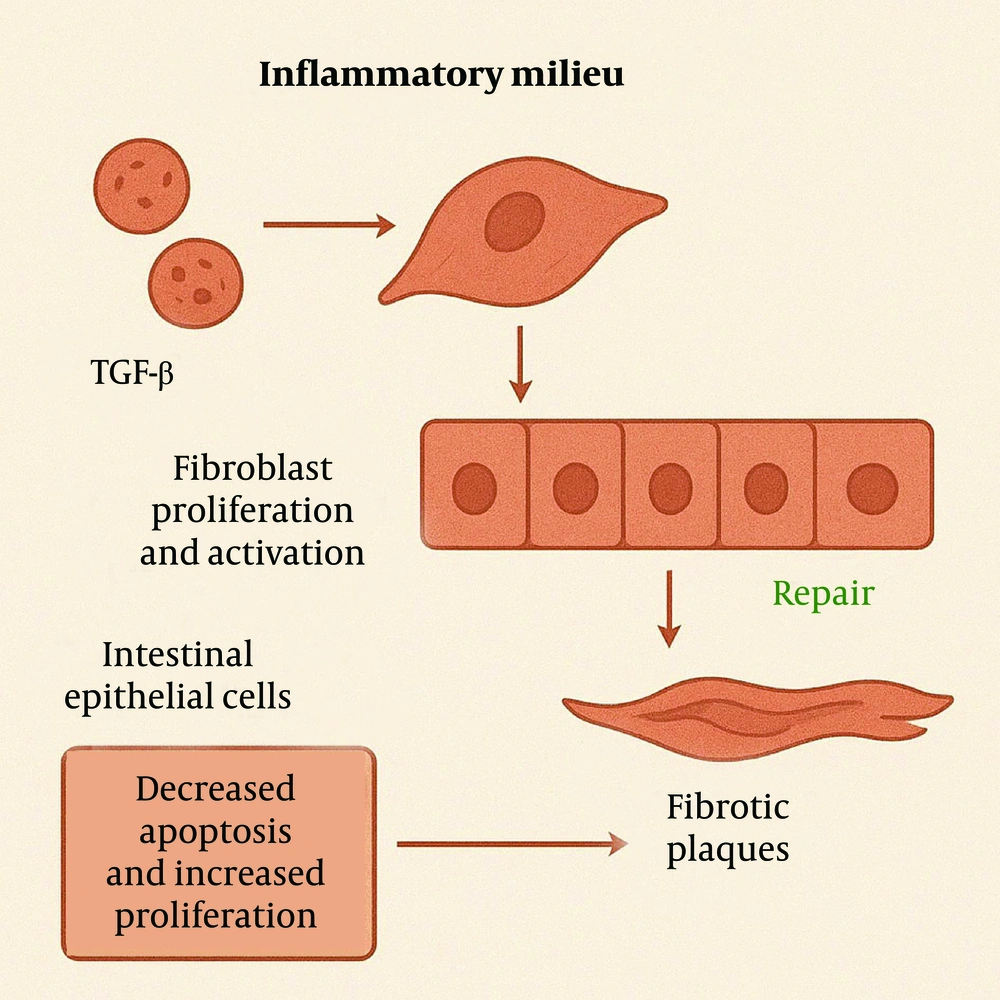 In chronic inflammation, growth factors stimulate fibroblast proliferation and extracellular matrix (ECM) production. Ineffective epithelial repair and reduced apoptosis lead to fibrotic plaque formation. In chronic inflammation, growth factors stimulate fibroblast proliferation and extracellular matrix (ECM) production. Ineffective epithelial repair and reduced apoptosis lead to fibrotic plaque formation.