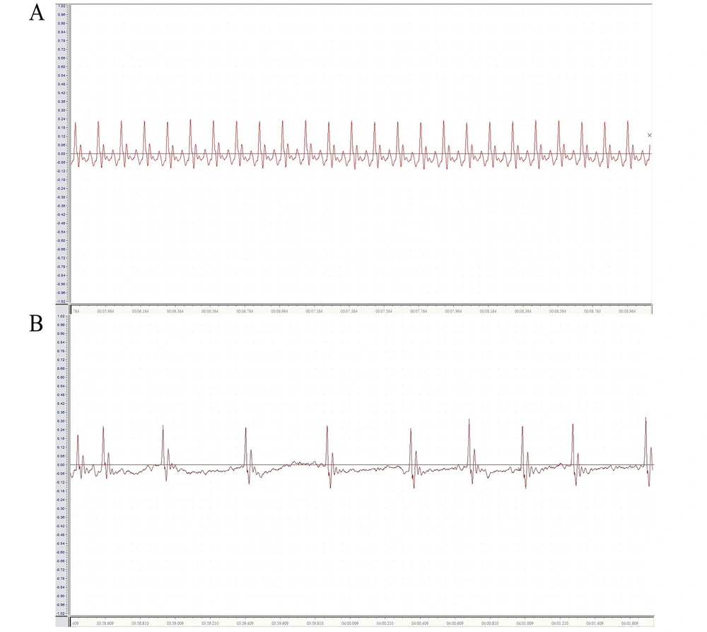 Electrocardiogram of rats. A, electrocardiogram of normal rats; B, electrocardiogram of atrial fibrillation (AF) rats. Electrocardiogram of rats. A, electrocardiogram of normal rats; B, electrocardiogram of atrial fibrillation (AF) rats.