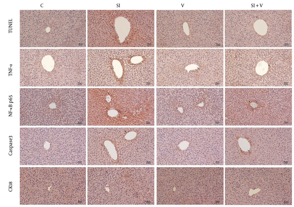 Representative Images of TUNEL and Immunohistochemical Staining for Inflammatory and Apoptotic Markers. Representative micrographs show TUNEL staining (row 1), TNF-alpha (row 2), NF-kappa B p65 (row 3), caspase-3 (row 4), and cytokeratin-18 (row 5) immunoexpression in the C, SI, V, and SI+V groups. All images are from perivenular regions. Increased numbers of TUNEL-positive nuclei and higher immunostaining intensity for TNF-alpha, NF-kappa B p65, and caspase-3 were observed in the SI group compared with the C and V groups. The SI+V group showed a partial reduction in staining compared with the SI group. Cytokeratin-18 staining was reduced in the SI group and partially preserved in the SI+V group (scale bars: 50 µm). Abbreviations: C, Control; SI, Social Isolation; V, Vortioxetine; SI+V, Social Isolation + Vortioxetine. Representative Images of TUNEL and Immunohistochemical Staining for Inflammatory and Apoptotic Markers. Representative micrographs show TUNEL staining (row 1), TNF-alpha (row 2), NF-kappa B p65 (row 3), caspase-3 (row 4), and cytokeratin-18 (row 5) immunoexpression in the C, SI, V, and SI+V groups. All images are from perivenular regions. Increased numbers of TUNEL-positive nuclei and higher immunostaining intensity for TNF-alpha, NF-kappa B p65, and caspase-3 were observed in the SI group compared with the C and V groups. The SI+V group showed a partial reduction in staining compared with the SI group. Cytokeratin-18 staining was reduced in the SI group and partially preserved in the SI+V group (scale bars: 50 µm). Abbreviations: C, Control; SI, Social Isolation; V, Vortioxetine; SI+V, Social Isolation + Vortioxetine.