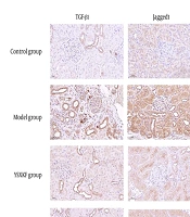 Yishen Xiaoke Formula Delays Renal Fibrosis in Rats with Diabetic Nephropathy by Suppressing the Transforming Growth Factor-Beta 1/Notch Signalling Pathway