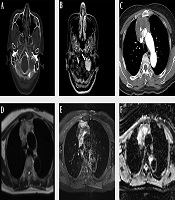Primary Thymic Mucinous Adenocarcinoma: A Case Report Focusing on Radiological Findings and Review of the Literature
