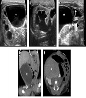 Diagnostic Value of Real-Time Ultrasound in Congenital Segmental Giant Megaureter: A Case Report