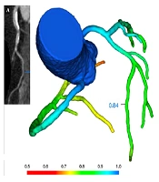 Increased Epicardial Fat Tissue is Predictor for Patients with Ischemia and No Obstructive Coronary Artery Disease