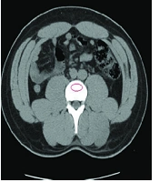 CT-Scan as an Opportunistic Osteoporosis Screening Tool in High-Risk Populations; A Diagnostic Study Conducted on a Sample of Urinary Stone Patients