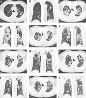 A Dynamic Follow-Up of Pneumonia Caused by Coronavirus Disease 2019 (COVID-19) on CT Scan