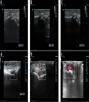 Cover image of the article: Role of 7-Joint Ultrasonic Score in Predicting the Prognosis of Rheumatoid Arthritis