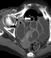 Obturator Hernia with Meckel’s Diverticulum Mimicking Incarcerated Small Bowel Hernia: A Case Report