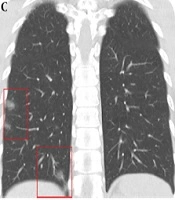 CT Imaging Features During Disease Progression of 2019 Novel Coronavirus (COVID-19) Pneumonia