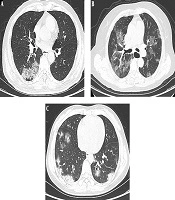 Clinical and Imaging Features of Novel Coronavirus Pneumonia in the Elderly Compared with Young and Middle-Aged Individuals