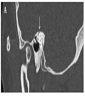 High-Resolution Three Dimensional MRI Findings After Plugging Surgery for Superior Semicircular Canal Dehiscence: A Case Report