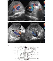 Ultrasonic Evaluation of Spontaneous Portosystemic Shunts in Patients with Budd-Chiari Syndrome