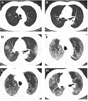 A Case Report of a Patient with Severe Type of Coronavirus Disease 2019 (COVID-19) Treated by Hyperbaric Oxygen: CT Dynamic Changes