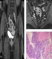 Magnetic Resonance Appearance of Pulmonary Type of Primary Small Cell Carcinoma of the Ovary: A Case Report and Literature Review