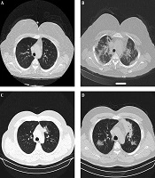 Performance of Low-Dose Chest CT Scan for Initial Triage of COVID-19