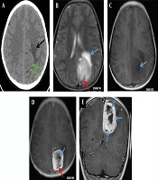 Intracranial Malignant Triton Tumor in Children: A Case Report