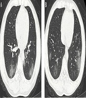 Application of Mobile Helical Computed Tomography in Combatting COVID-19