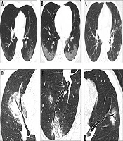 Comparison of Clinical and Chest CT Characteristics of Adult Patients with COVID-19 and Mycoplasma Pneumonia