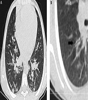 A Case Series of COVID-19 Respiratory Infection in Hospitalized Children: Clinical and Computed Tomography Challenges