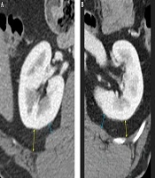 Assessment of Patient-Related Operative Complexity During Partial Nephrectomy: Comparison of Two Tailored Methods for Measurement of Posterior Perinephric Fat Thickness on Preoperative CT