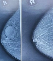 History of Mammography in Iran