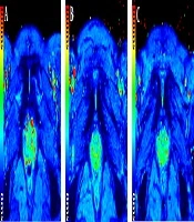 Quantitative Evaluation of Pubic Symphysis in Late Pregnancy Using T2* Mapping