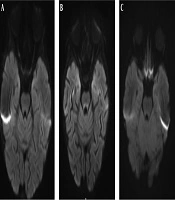 Radiological Significance of Symmetric Central Tegmental Tract Hyperintensity in Pediatric Patients