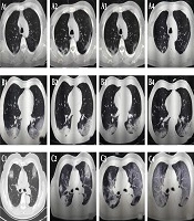 Correlation Between Dynamic Changes of Chest CT Findings and Therapeutic Response of COVID-19: A Multicenter Experience in Shanghai, China
